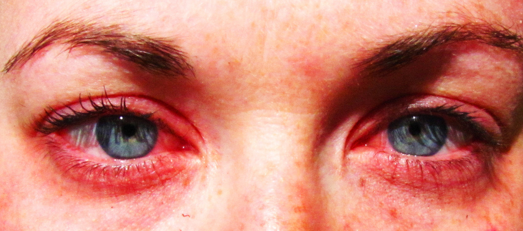 Eye Allergies MarijuanaWellness Eye Allergies MarijuanaWellness